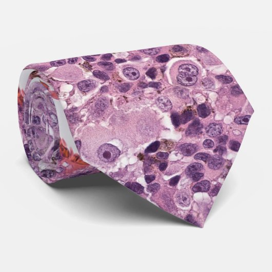 Cravate épithélioïde uveal melanoma (Roulé)