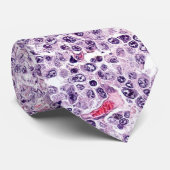 Cravate lymphome à grande cellule (Roulé)