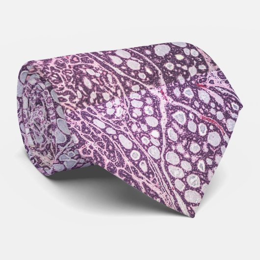 Cravate présentant un carcinome kystique adénoïde (Roulé)