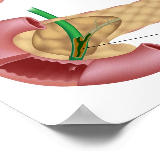 Cystische fibrose Poster (Hoek)