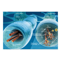 Disïntegratie van microtubuli in een neuron