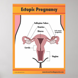 Ectopic Zwangerschap Poster