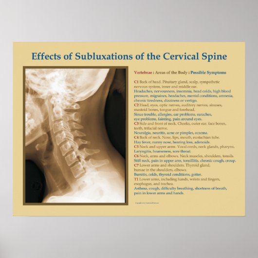 Effecten van cervicale spinale subluxatie Poster (Voorkant)