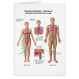 Embolie pulmonaire, voie d'embole