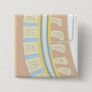 Epidurale anesthesie vierkante button 5,1 cm