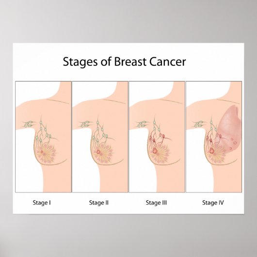 Étapes du cancer du sein Poster (Devant)