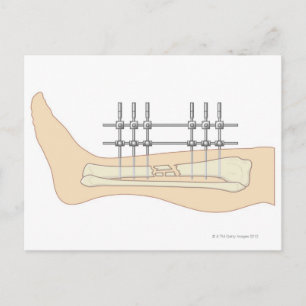 Externe fixator briefkaart