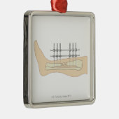 Externe fixator metalen ornament (Rechts)