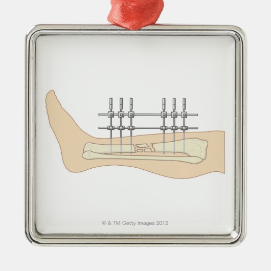 Externe fixator metalen ornament (Voorkant)