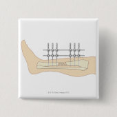 Externe fixator vierkante button 5,1 cm (Voorkant)