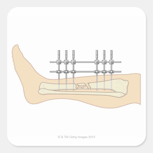 Externe fixator vierkante sticker (Voorkant)
