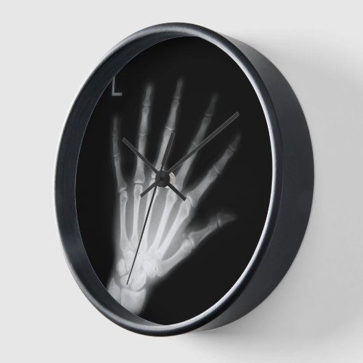 Extra Digit X-ray Left Hand (Hoek)