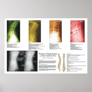 Fasen Lumbar Spinal Degeneration Poster