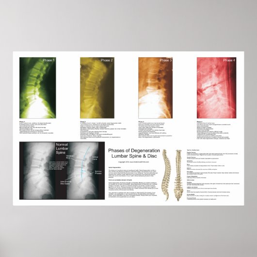 Fasen Lumbar Spinal Degeneration Poster (Voorkant)