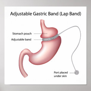 Gastric Band Weight Loss Surgery  Poster