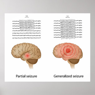 GEE bij partiële en gegeneraliseerde epilepsie-Pos Poster