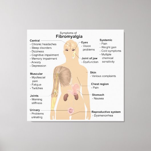 Grafiek Tekenen Symptomen Fibromyalgie Canvas Prin Afdruk (Voorkant)