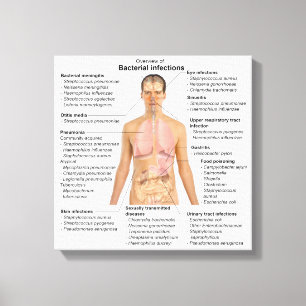 Grafiek van de bacteriële infecties bij de mens  canvas afdruk