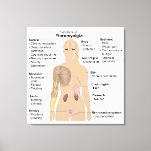 Graphique Signes Symptômes Fibromyalgie Impression