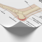 Haglund-misvorming Cadeaupapier (Hoek)