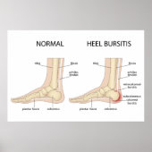 Haglund-misvorming Poster (Voorkant)