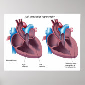 Harthypertrofie Poster (Voorkant)