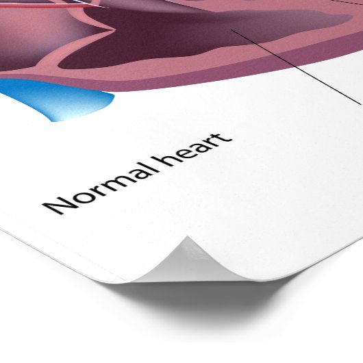 Heart hypertrophy Poster (Coin)