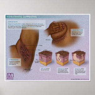 Hidradenitis Melalogique Supprativa Poster Médical