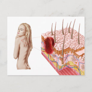 Illustratie van een atypische groei van de huid briefkaart