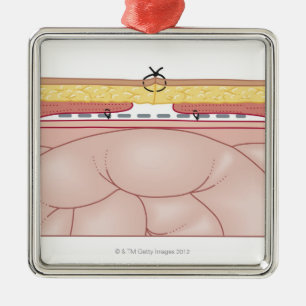 Illustratie van een hernia metalen ornament