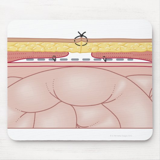 Illustratie van een hernia muismat (Voorkant)
