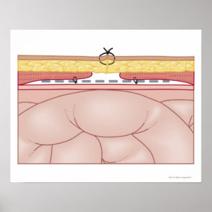 Illustratie van een hernia poster
