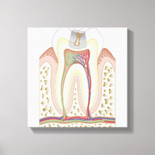 Illustratie van het Tooth Decay Canvas Afdruk