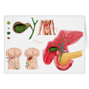 Illustration dépeignant la cholécystectomie