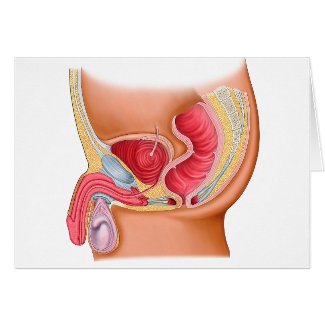 Illustration Médicale D'Une Fistule Rectouréthrale (Devant horizontal)