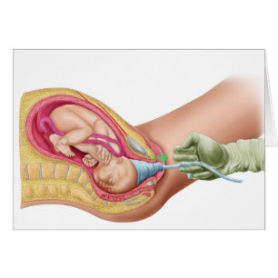 Illustration Montrant La Livraison Du Foetus 1