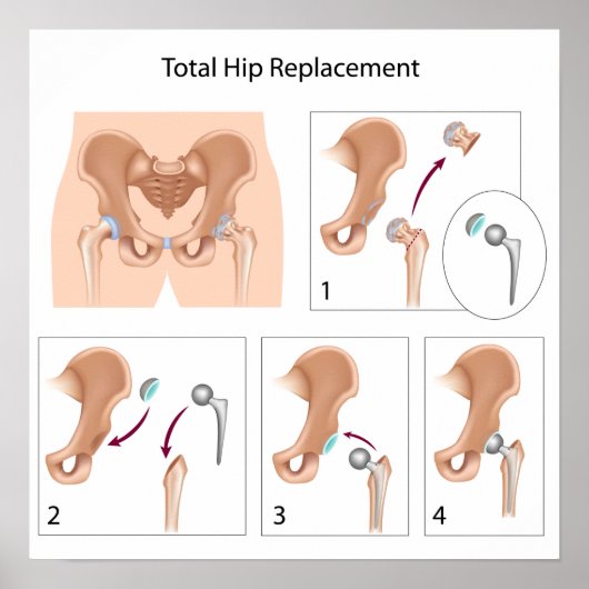 Impression de chirurgie de remplacement de la hanc (Devant)