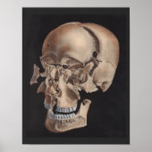 Impression du crâne éclaté désarticulé (Devant)