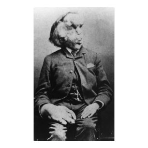 Joseph "John" Merrick The Elephant Man uit 1889 Foto Afdruk
