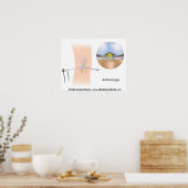 Knie-artroscopiediagram. Poster (Keuken)