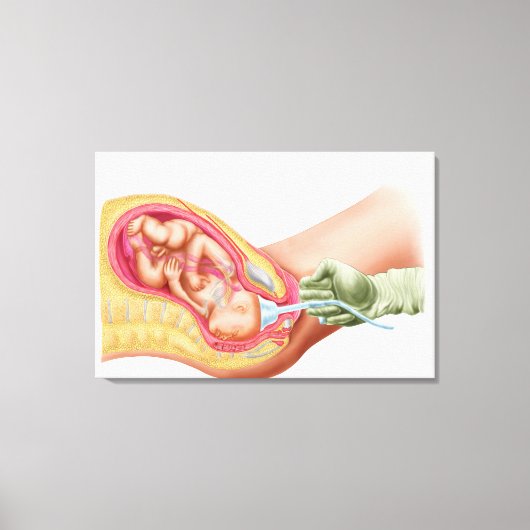 Levering foetus met vacuümextractie canvas afdruk (Voorkant)