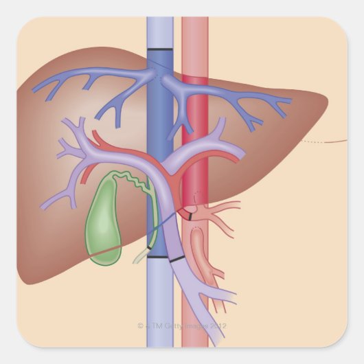 Levertransplantatieprocedure Vierkante Sticker (Voorkant)
