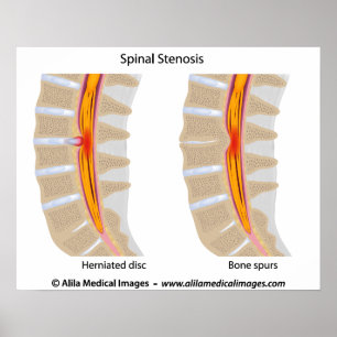 Lumbar Spinale Stenosis, medische tekening. Poster