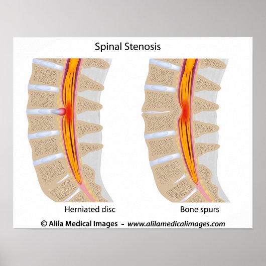 Lumbar Spinale Stenosis, medische tekening. Poster (Voorkant)