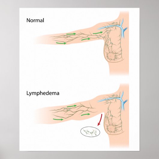 lymfoedeem arm poster (Voorkant)