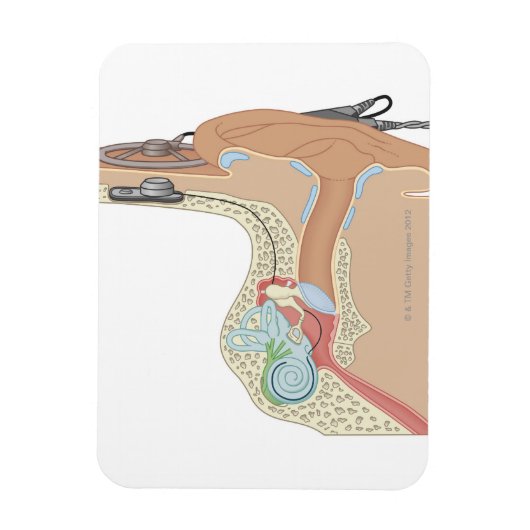 Magnet Flexible Implants cochléaires (Vertical)