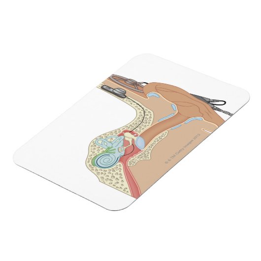 Magnet Flexible Implants cochléaires (Côté Gauche)