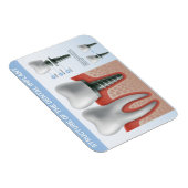 Magnet Flexible Structure de l'implant dentaire (Côté Droit)