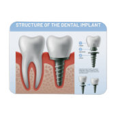Magnet Flexible Structure de l'implant dentaire (Horizontal)