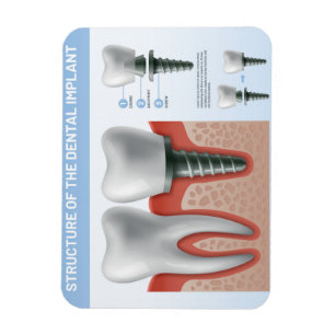 Magnet Flexible Structure de l'implant dentaire